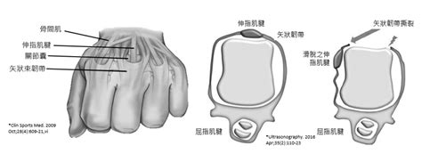 矢狀帶斷裂